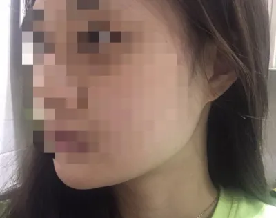 [微整] 妮娜的 - 溶脂針、拉提