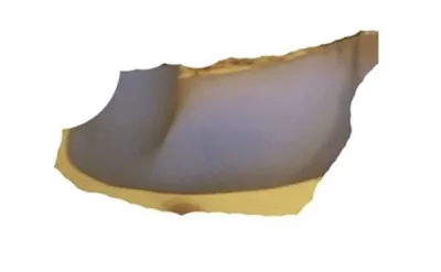 [抽脂] 無止境 - 抽脂