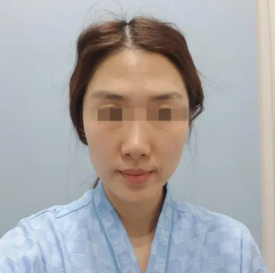 [微整形] 彬彬家 - 全臉脂肪移植