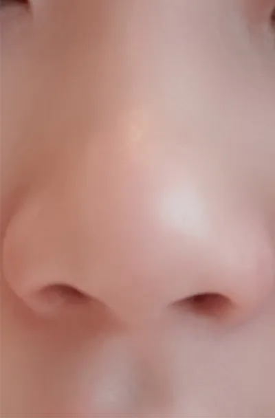 [微整] 7時11分 - 鼻雕塑注射