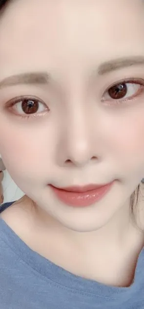 [眼睛] songi1938 - 後眼角切開,下眼瞼下至