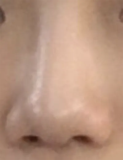 [微整形] dbwladl - 鼻子