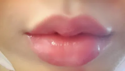 [微整] 鍾愛的 정든2 - 嘴唇填充