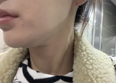 [微整形] 魯道夫媽媽 - 肉毒桿菌、輪廓針