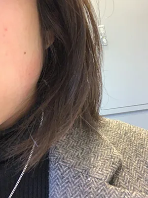 [微整形] 憂鬱的季節 - 下顎肉毒桿菌