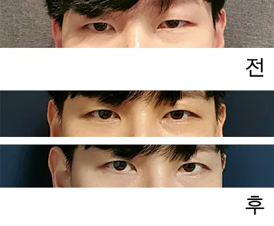 [眼睛] WDHH - 眼型矯正