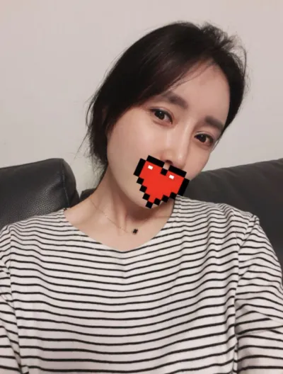 [抗衰老] ㅅㄴㄷㄴㅅㅊ - 眼睛、脂肪移植