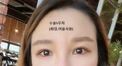 [眼睛] 我的眼睛 - 眼部整形