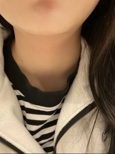 [微整] 下巴 - 音波拉提