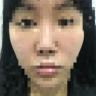 [微整] yuyya - 輪廓針