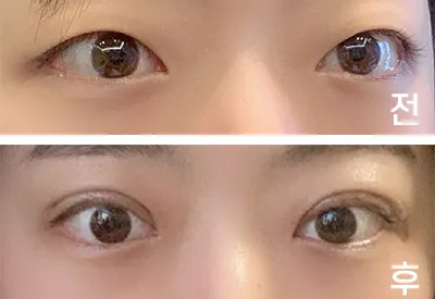 [眼睛] 屋頂s2 - 上眼瞼提拉、眼型矯正