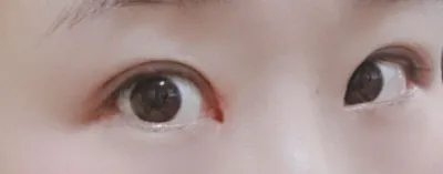 [眼睛] 핑구찐 - 眼型矯正、開眼頭/眼尾