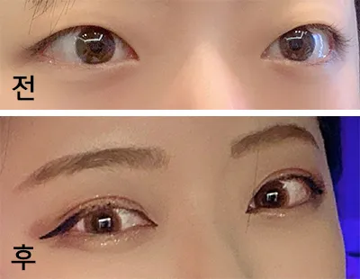 [眼睛] 屋頂S2 - 上眼瞼提拉、眼型矯正