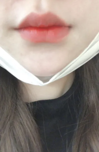 [微整] Liligirl - 嘴唇填充