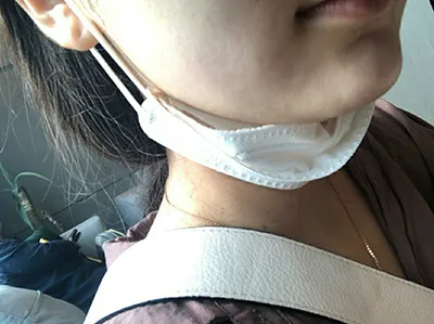 [皮膚] 熊三 - 音波拉提