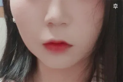 [抗衰老] alss12 - 面部抽脂