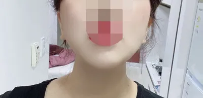 [抽脂] B Mask海 - 臉部抽脂