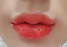 [微整形] 多熙 Ying - 填充劑