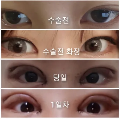 [眼睛] 高氣靈 - 雙眼皮、開眼頭、開眼尾