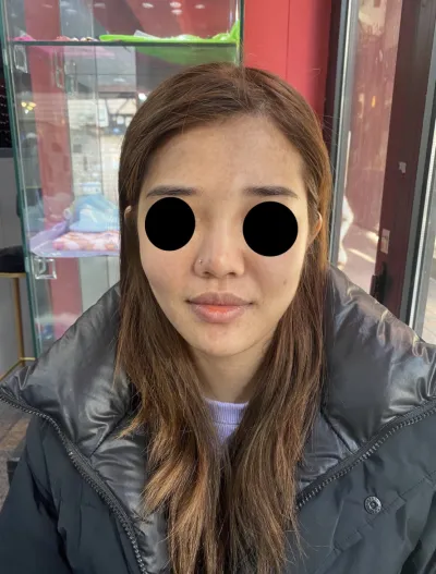 [抗衰老] ppkim0119 - 脂肪移植