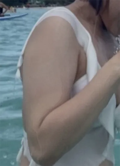 [抽脂] 徐睿知 - 手臂