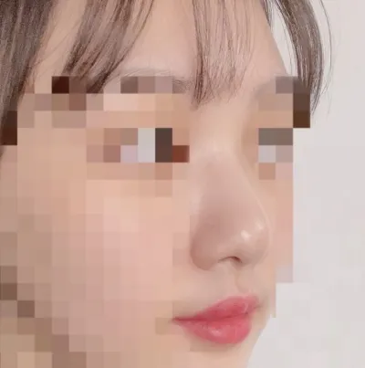 [鼻] Longdarangsa - 隆鼻手術