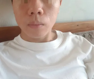 [鼻] 鼻翼缩小 - 鼻子