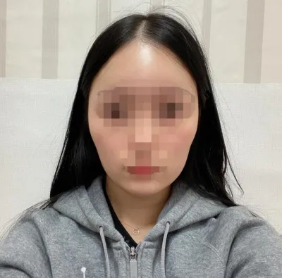 [顏面輪廓] 檸檬55 - 下顎角手術、下巴尖縮小