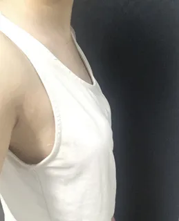 [隆胸]下午2點 - 隆胸