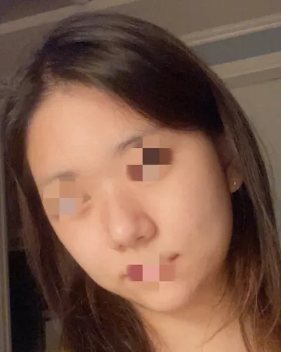 [顏面輪廓] 아이셔 - 輪廓、鼻子、臉部吸脂