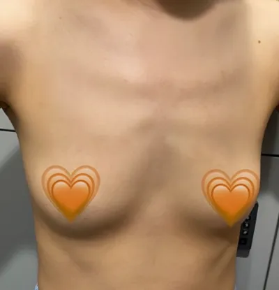 [隆胸] 彈彈球 - 胸部