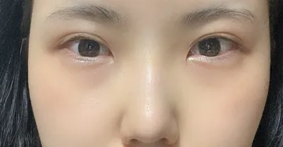 [眼部] 뿔난 - 眼、鼻手術