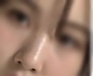 [鼻] 鼻部整形 - 我的鼻子