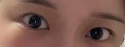 [眼睛] 秀PIAN - 眼睛、脂肪移植