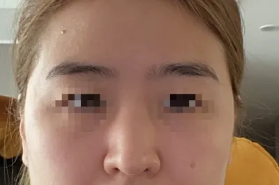 [鼻部] 明智斯 - 鼻部、脂肪移植