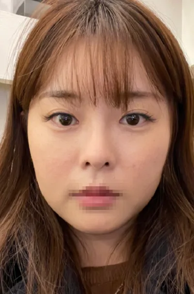 [顏面輪廓] 合井咖啡 - 眼、鼻、臉部抽脂、輪廓手術