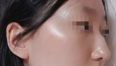 [鼻] 皮諾丘 - 鼻