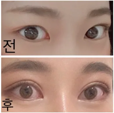 [眼部] 호호바 - 眼部、鼻部、額頭拉提