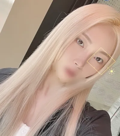 [鼻部] Elysia - 鼻部、眼下脂肪重新配置