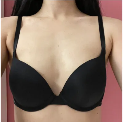 [隆胸] 梁梁 - 胸部