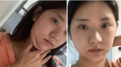 [顏面輪廓] 角質 - 輪廓、鼻子