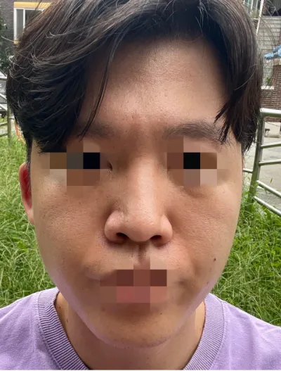 [鼻] 蒜頭鼻 - 鼻