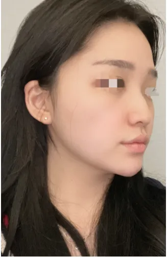 [鼻部] Love U - 鼻