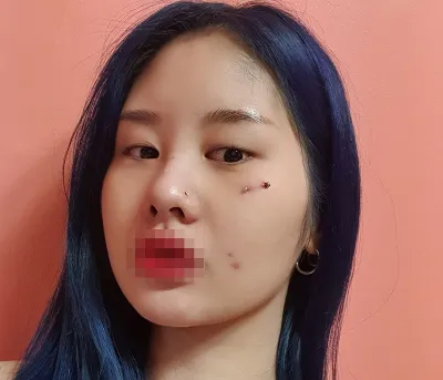 [眼睛] 義父最棒 - 眼睛、臉部抽脂