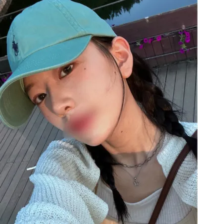 [鼻] 醜醜鼻 - 鼻