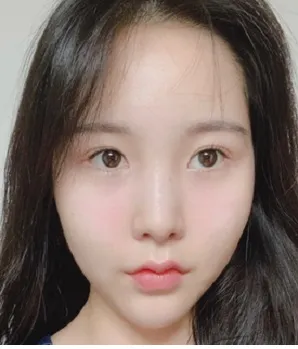 [鼻] 鼻部整形後記 - 鼻