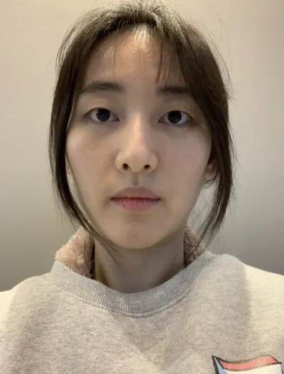 [眼睛] 朴明洙 - 埋線雙眼皮, 填充