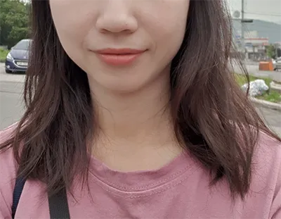 [微整] 向日葵ssi - 音波拉提、輪廓肉毒