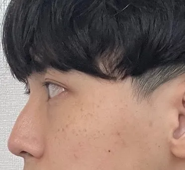 [鼻] 髖關節鉸鏈 - 鼻