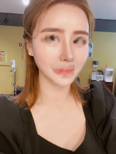 [抗衰老] 接受提問 - 全臉脂肪移植、隆鼻